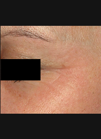 Skin-Renewal-after-3 Houston Wellness & Aesthetics|Before and After Gallery