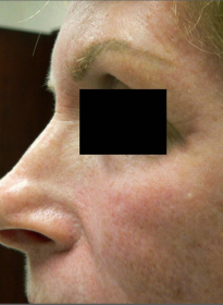 Skin-Renewal-after Houston Wellness & Aesthetics|Before and After Gallery