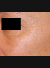 Skin-Renewal-before-2 Houston Wellness & Aesthetics|Before and After Gallery