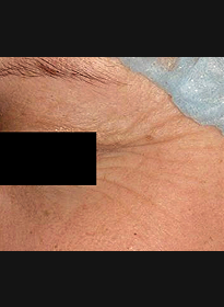 Skin-Renewal-before-3 Houston Wellness & Aesthetics|Before and After Gallery