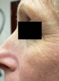 Skin-Renewal-before Houston Wellness & Aesthetics|Before and After Gallery