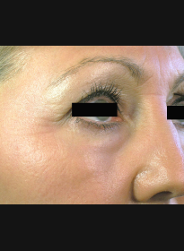 Skin-Resurfacing-after-2 Houston Wellness & Aesthetics|Before and After Gallery