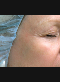 Skin-Resurfacing-after-3 Houston Wellness & Aesthetics|Before and After Gallery