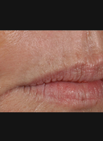 Skin-Resurfacing-after-4 Houston Wellness & Aesthetics|Before and After Gallery