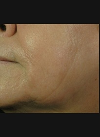 Skin-Resurfacing-after Houston Wellness & Aesthetics|Before and After Gallery