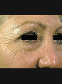 Skin-Resurfacing-before-2 Houston Wellness & Aesthetics|Before and After Gallery