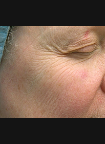 Skin-Resurfacing-before-3 Houston Wellness & Aesthetics|Before and After Gallery