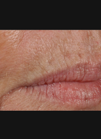 Skin-Resurfacing-before-4 Houston Wellness & Aesthetics|Before and After Gallery