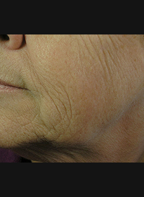 Skin-Resurfacing-before Houston Wellness & Aesthetics|Before and After Gallery