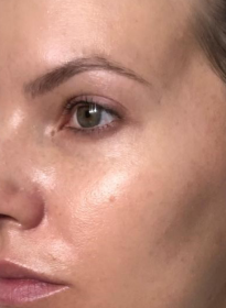 Skin-Revitalization-after-10 Houston Wellness & Aesthetics|Before and After Gallery