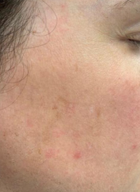 Skin-Revitalization-after-11 Houston Wellness & Aesthetics|Before and After Gallery