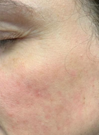 Skin-Revitalization-after-12 Houston Wellness & Aesthetics|Before and After Gallery