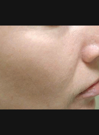 Skin-Revitalization-after-13 Houston Wellness & Aesthetics|Before and After Gallery