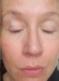 Skin-Revitalization-after-14 Houston Wellness & Aesthetics|Before and After Gallery