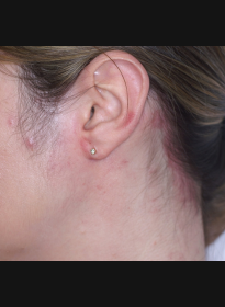 Skin-Revitalization-after-16 Houston Wellness & Aesthetics|Before and After Gallery