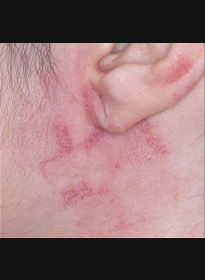 Skin-Revitalization-after-17 Houston Wellness & Aesthetics|Before and After Gallery