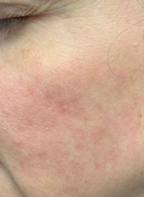 Skin-Revitalization-after-18 Houston Wellness & Aesthetics|Before and After Gallery