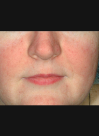 Skin-Revitalization-after-2 Houston Wellness & Aesthetics|Before and After Gallery