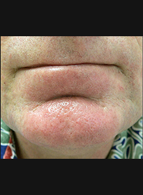 Skin-Revitalization-after-3 Houston Wellness & Aesthetics|Before and After Gallery