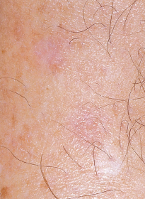 Skin-Revitalization-after-4 Houston Wellness & Aesthetics|Before and After Gallery