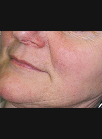 Skin-Revitalization-after-5 Houston Wellness & Aesthetics|Before and After Gallery