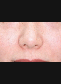 Skin-Revitalization-after-6 Houston Wellness & Aesthetics|Before and After Gallery