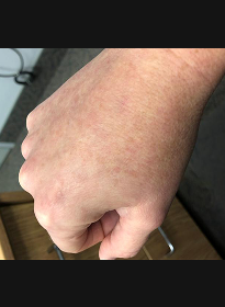 Skin-Revitalization-after-7 Houston Wellness & Aesthetics|Before and After Gallery