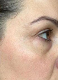 Skin-Revitalization-after-8 Houston Wellness & Aesthetics|Before and After Gallery