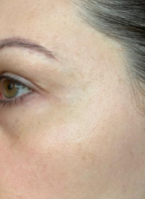 Skin-Revitalization-after-9 Houston Wellness & Aesthetics|Before and After Gallery