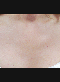 Skin-Revitalization-after Houston Wellness & Aesthetics|Before and After Gallery