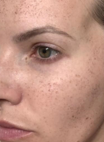 Skin-Revitalization-before-10 Houston Wellness & Aesthetics|Before and After Gallery