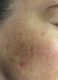 Skin-Revitalization-before-11 Houston Wellness & Aesthetics|Before and After Gallery