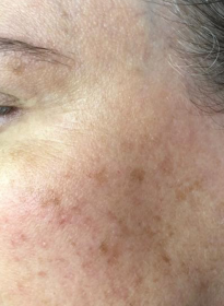 Skin-Revitalization-before-12 Houston Wellness & Aesthetics|Before and After Gallery
