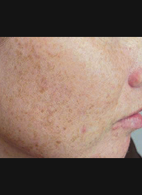 Skin-Revitalization-before-13 Houston Wellness & Aesthetics|Before and After Gallery
