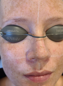 Skin-Revitalization-before-14 Houston Wellness & Aesthetics|Before and After Gallery