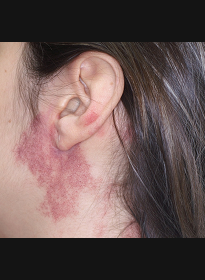 Skin-Revitalization-before-16 Houston Wellness & Aesthetics|Before and After Gallery