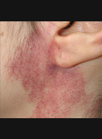 Skin-Revitalization-before-17 Houston Wellness & Aesthetics|Before and After Gallery