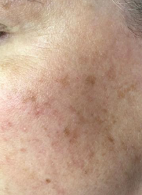 Skin-Revitalization-before-18 Houston Wellness & Aesthetics|Before and After Gallery