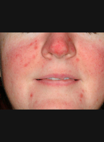 Skin-Revitalization-before-2 Houston Wellness & Aesthetics|Before and After Gallery