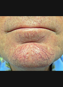 Skin-Revitalization-before-3 Houston Wellness & Aesthetics|Before and After Gallery