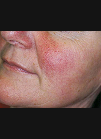 Skin-Revitalization-before-5 Houston Wellness & Aesthetics|Before and After Gallery