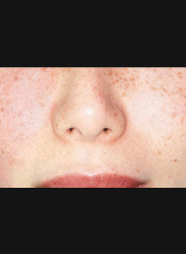 Skin-Revitalization-before-6 Houston Wellness & Aesthetics|Before and After Gallery