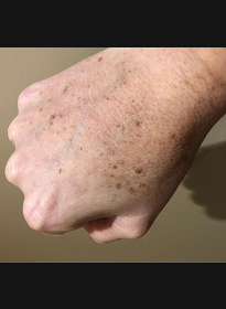 Skin-Revitalization-before-7 Houston Wellness & Aesthetics|Before and After Gallery