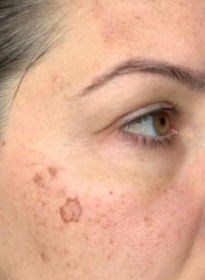 Skin-Revitalization-before-8 Houston Wellness & Aesthetics|Before and After Gallery