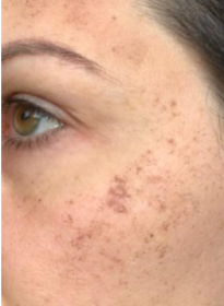 Skin-Revitalization-before-9 Houston Wellness & Aesthetics|Before and After Gallery