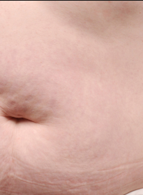 Stretch-Mark-after-2 Houston Wellness & Aesthetics|Before and After Gallery