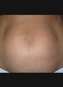 Stretch-Mark-after-3 Houston Wellness & Aesthetics|Before and After Gallery