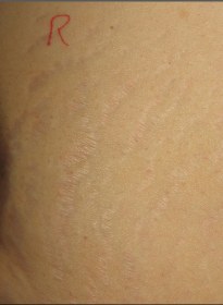 Stretch-Mark-after-4 Houston Wellness & Aesthetics|Before and After Gallery