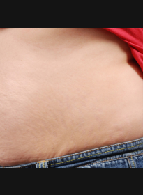 Stretch-Mark-after Houston Wellness & Aesthetics|Before and After Gallery