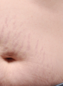 Stretch-Mark-before-2 Houston Wellness & Aesthetics|Before and After Gallery